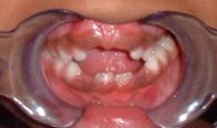 Orofacial Rest Before Therapy photo