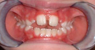 Orofacial Rest Before Therapy photo