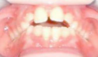 Orofacial Rest Before Therapy photo