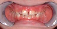 Orofacial Rest Before Therapy photo